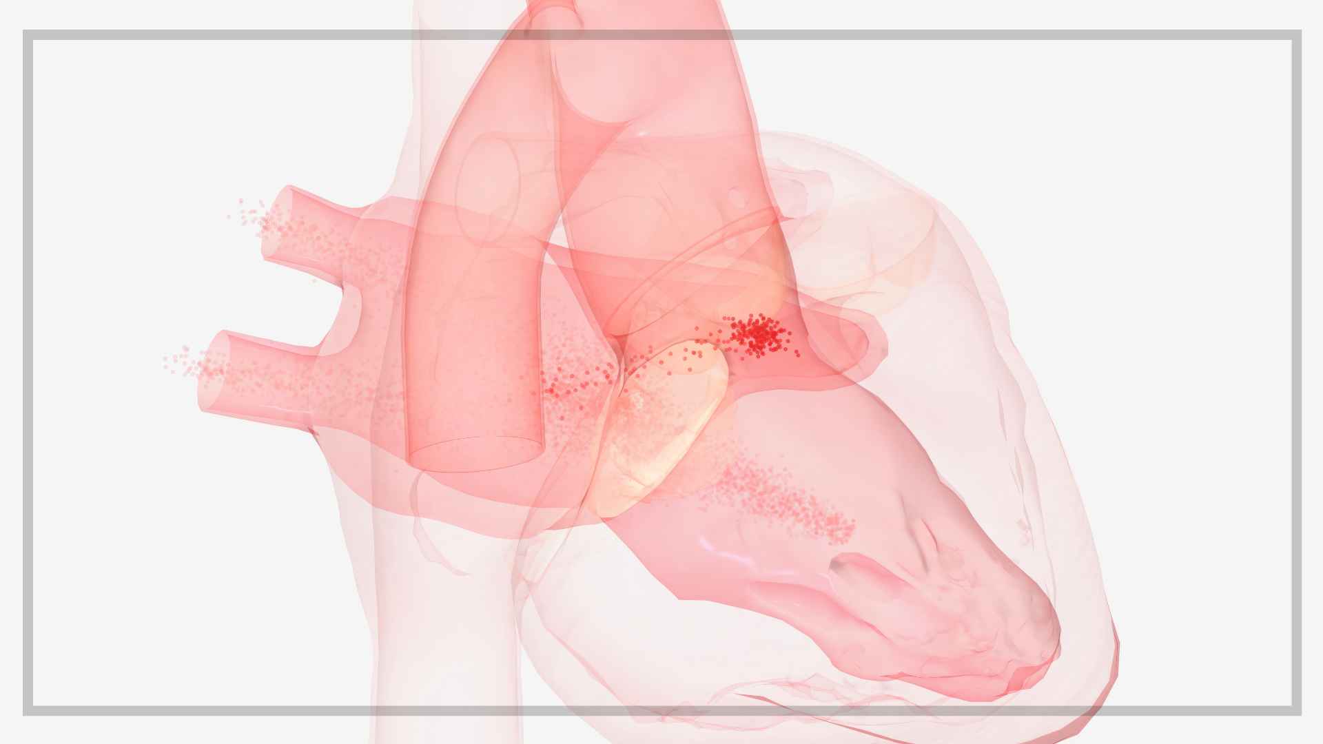 직장 스트레스와 심방세동 위험: 18년 추적 연구의 충격적 결과
